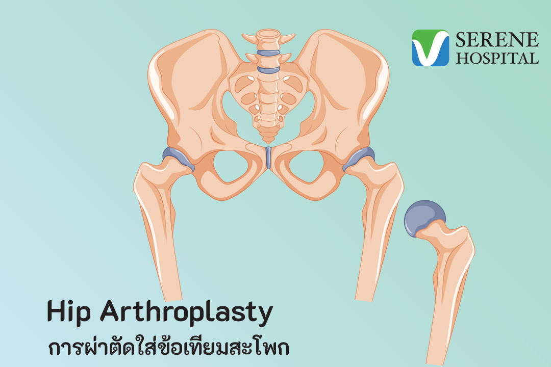 ดูแลหลังผ่าตัดใส่ข้อเทียมบริเวณสะโพก
